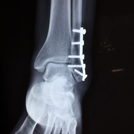 ankle, fracture, foot-2253057.jpg